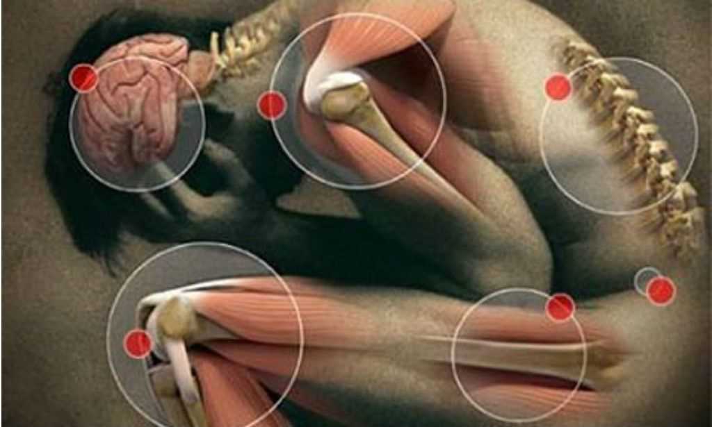 Fibromialgia: A "doença invisível" com dores reais insuportáveis portalraizes.com - Fibromialgia: A "doença invisível" com dores reais insuportáveis