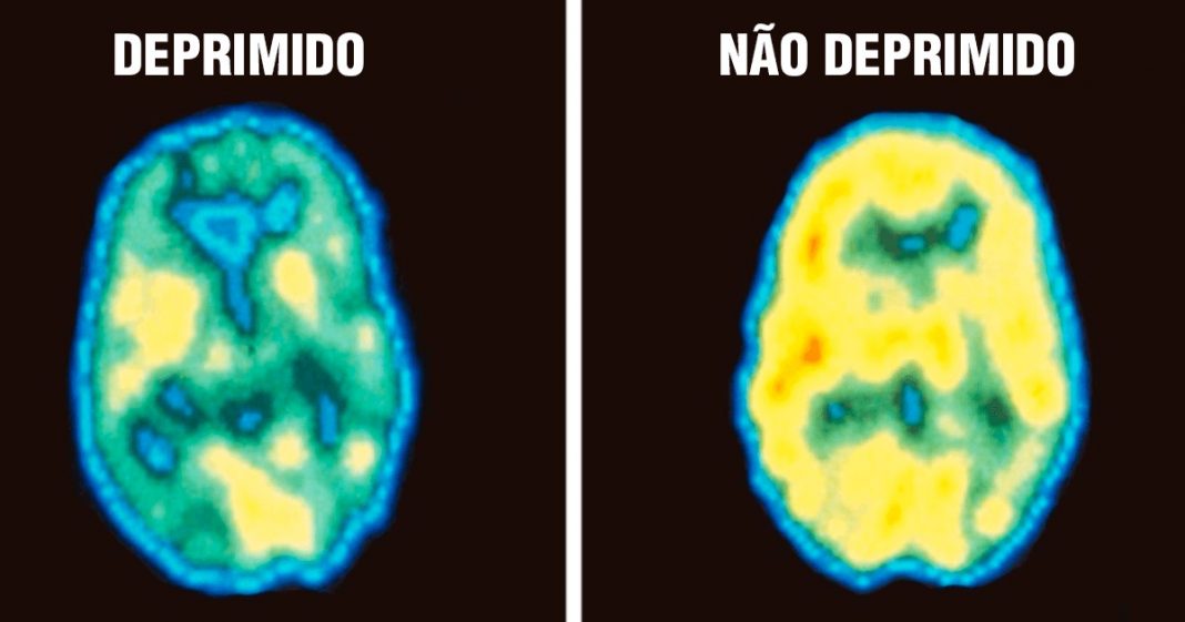 Nova pesquisa diz que a depressão é uma forma de dano cerebral