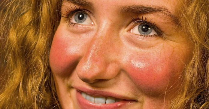 3473-blushed_cheeks-1296x728-slide1