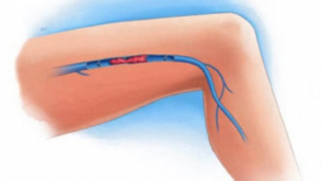 Sintomas de uma trombose venosa nas pernas
