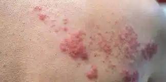 Depois dos 50 é preciso tomar a vacina contra o herpes-zóster