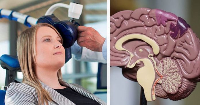 Terapia de Neuromodulação Inteligente Acelerada de Stanford 2