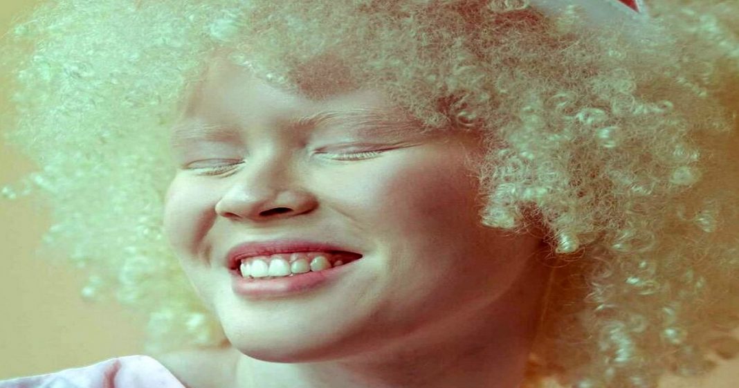 Ana: negra, albina e cega é aprovada em 1º lugar nas cotas para psicologia na USP