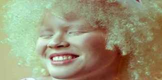 Ana: negra, albina e cega é aprovada em 1º lugar nas cotas para psicologia na USP