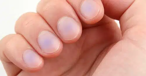 portalraizes.com - A apar&ecirc;ncia das unhas conta como est&aacute; a sa&uacute;de f&iacute;sica e mental, alerta especialistas