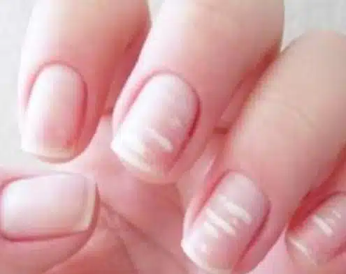 portalraizes.com - A apar&ecirc;ncia das unhas conta como est&aacute; a sa&uacute;de f&iacute;sica e mental, alerta especialistas