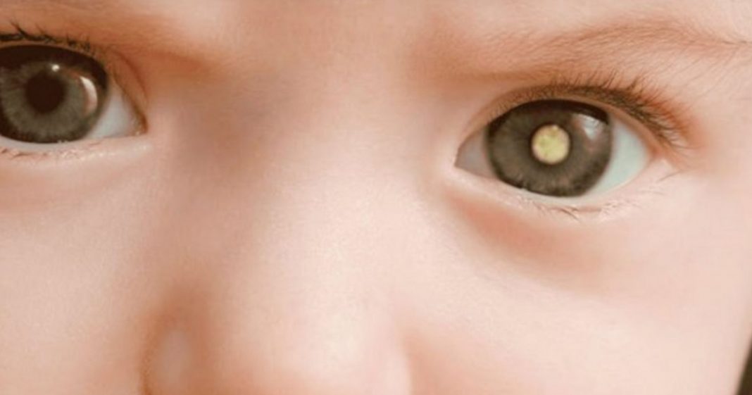 O que é retinoblastoma e como identificar os sinais em bebês