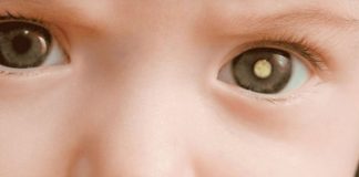 O que é retinoblastoma e como identificar os sinais em bebês