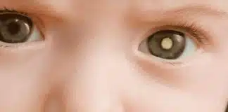 O que é retinoblastoma e como identificar os sinais em bebês