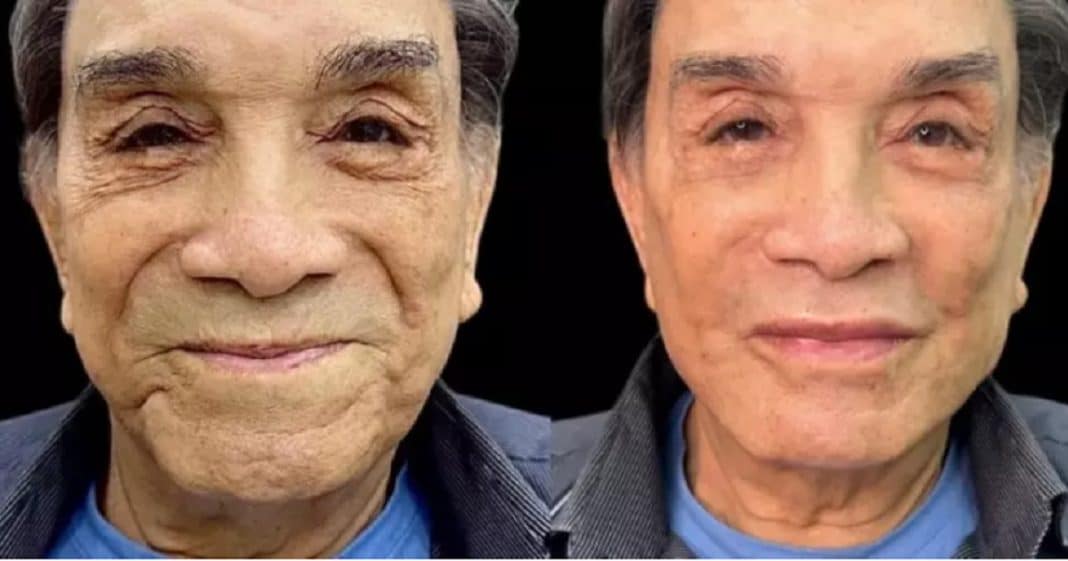 Aos 86 anos, o ex Trapalhão Dedé Santana faz harmonização facial