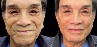 Aos 86 anos, o ex Trapalhão Dedé Santana faz harmonização facial